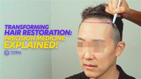 precision medical hair|Transforming Hair Restoration: Precision Medicine Explained .